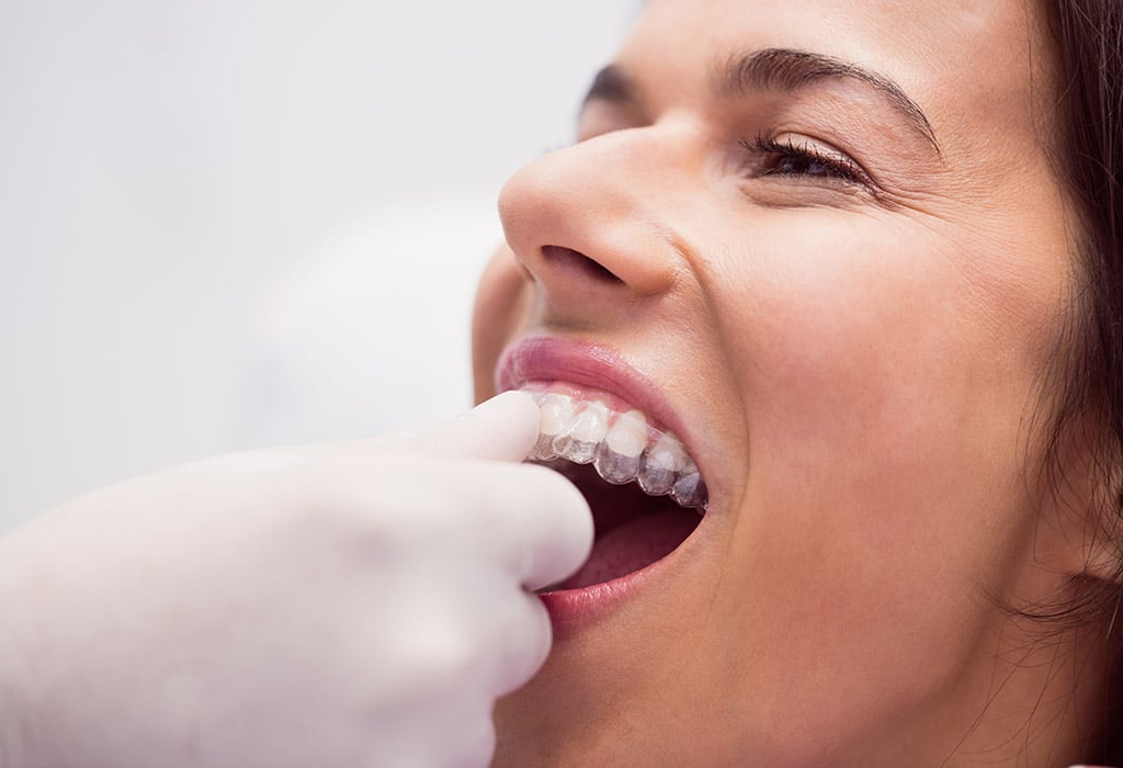 Dentista colocando ortodoncia invisible a una mujer adulta